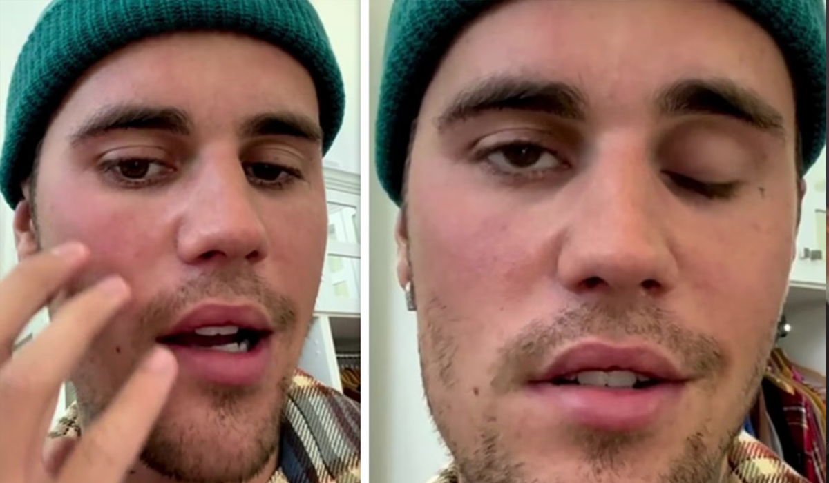 Justin Bieber shares paralysis diagnosis after getting Ramsay Hunt syndrome